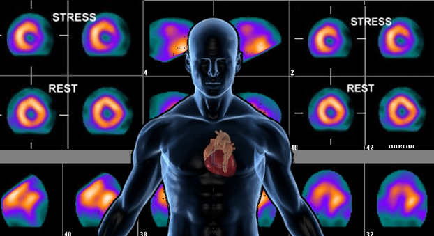 nuclear medicine scan heart